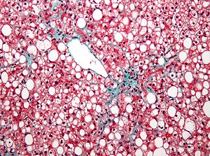 Nhiều giọt mỡ (màu trắng) trong các tế bào gan trên tiêu bản sinh thiết gan
